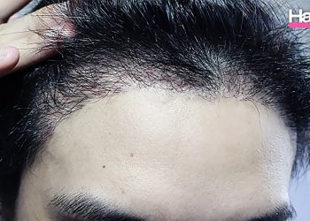 ศัลยกรรมปลูกผม เรื่องใหม่ที่หลายคนไม่รู้